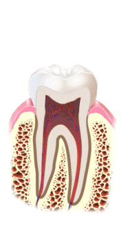 Animation traitement du canal de la dent - endodontie - dévitalisation